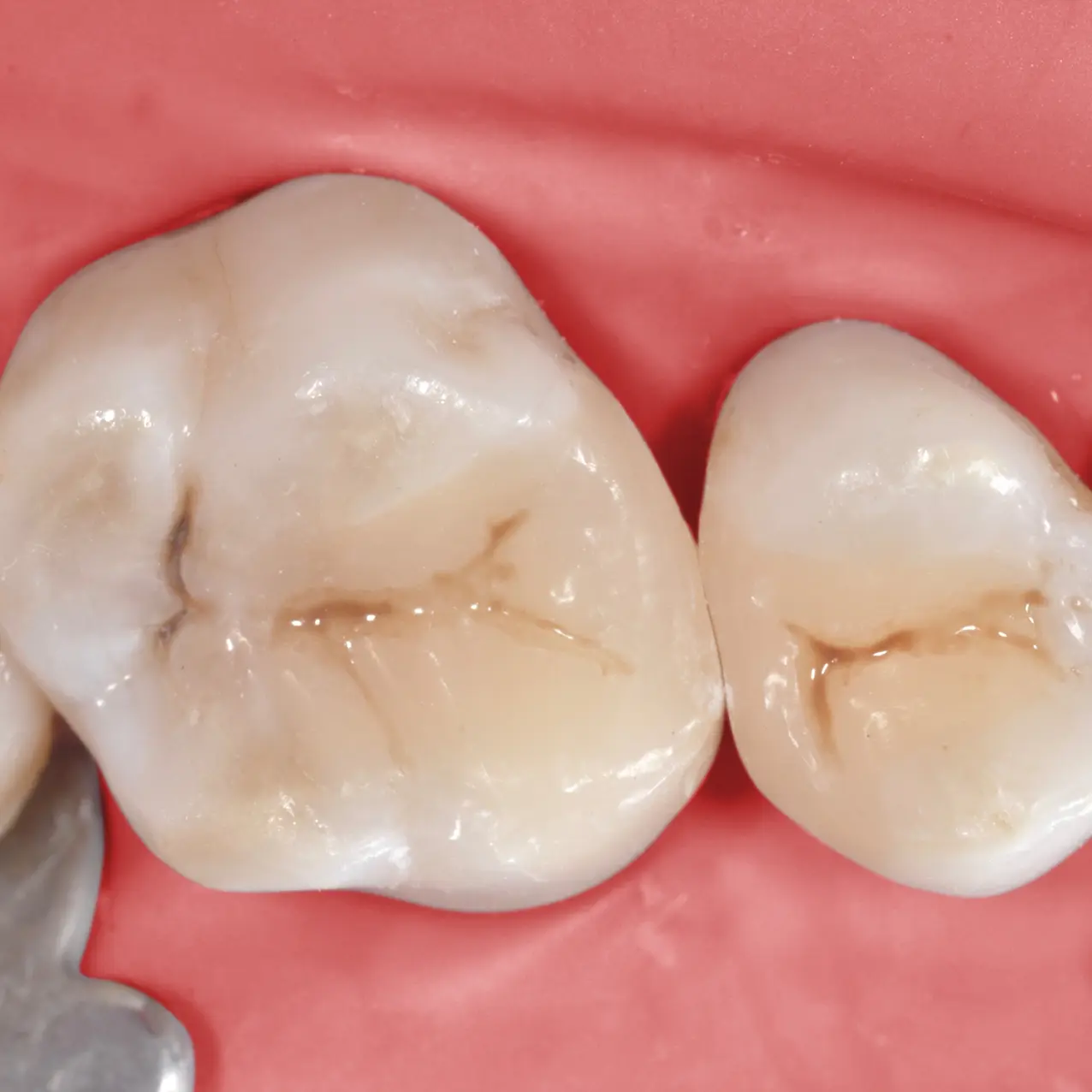 Studio dentistico GTF - casi clinici
